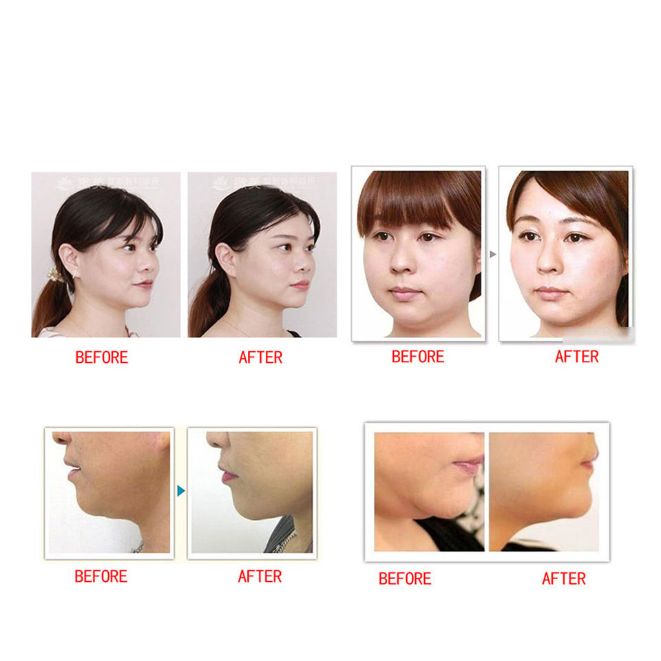 Double Chin Reduction Face Mask with Lifting Bandage Facial Belt for Thinning and Toning ﻿