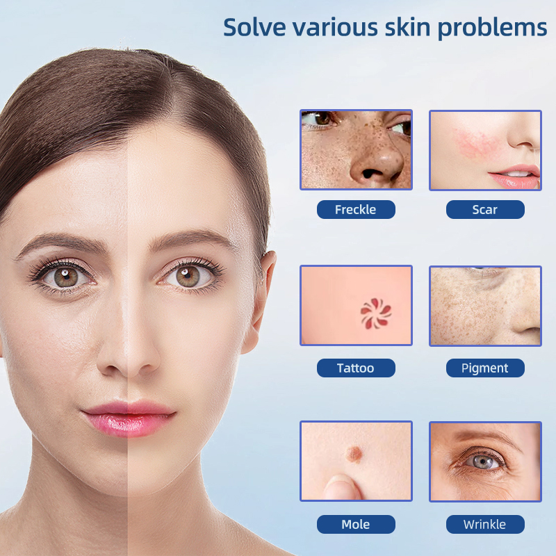 professional skin care device plasma pen for face lift removal pen plasma freckle mole remover machine