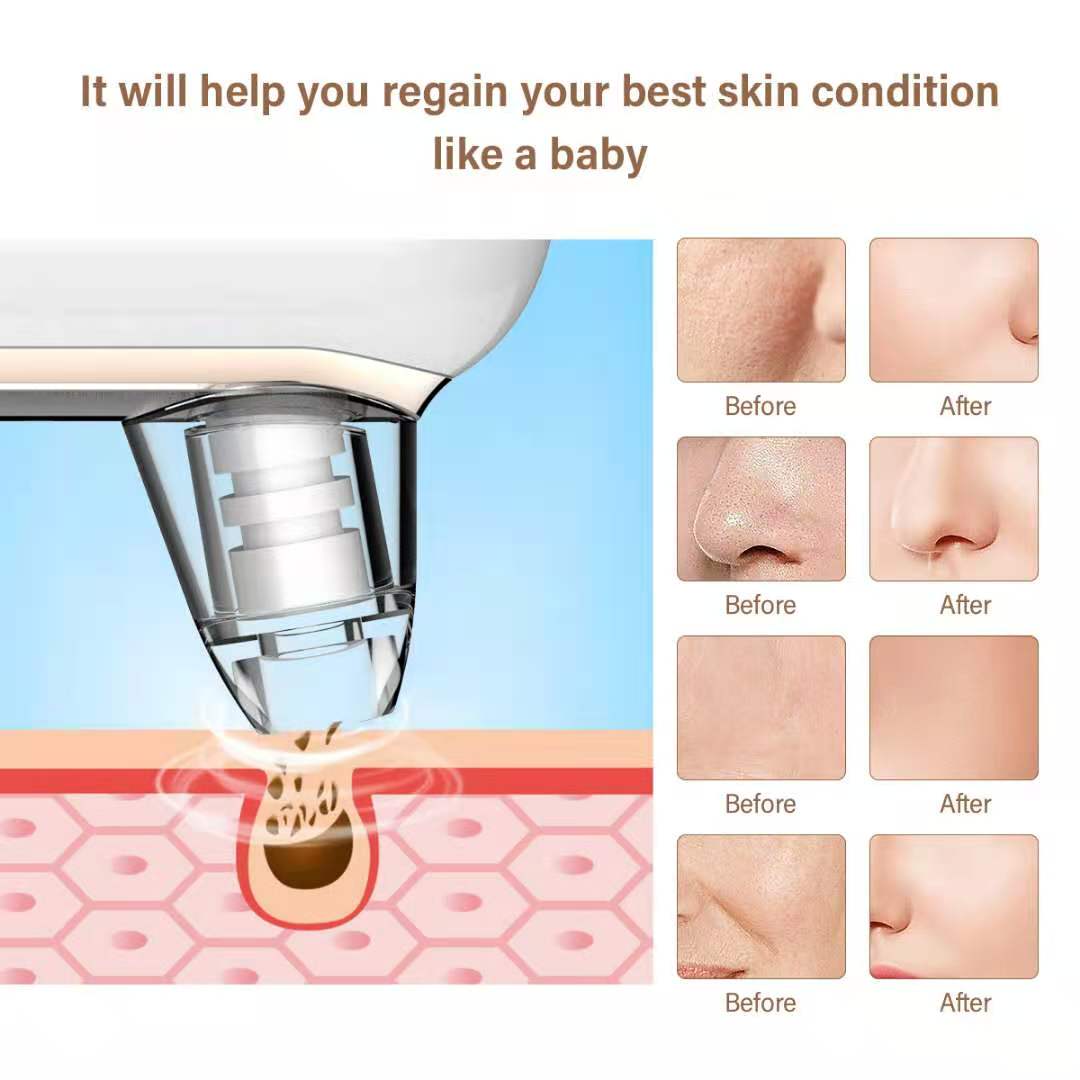 Blackhead Remover Spot Suction Electric Facial Pore Cleaner Skincare Exfoliating Beauty Instrument Black 3 Levels about 