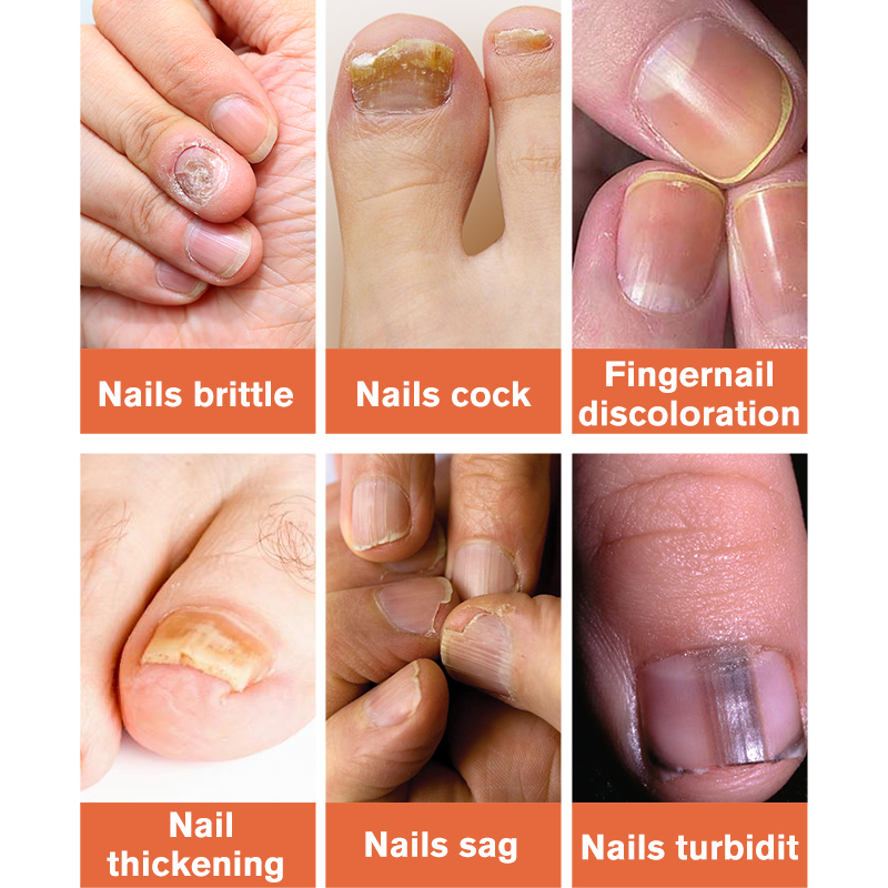 Lanthome natural organic pure treatment nourishing anti fungus smooth and hydrates nail care product nail repair serum e