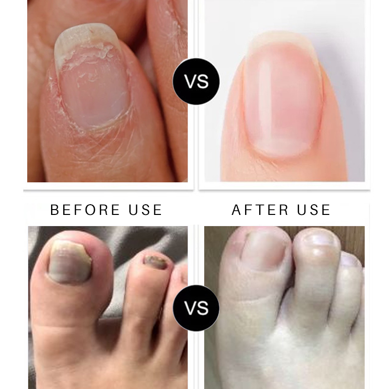 Lanthome natural organic pure treatment nourishing anti fungus smooth and hydrates nail care product nail repair serum e